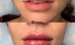 Контурная пластика Пластичний хірург Дмитрий Березовский Київ