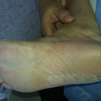 апаратный педикюр - до