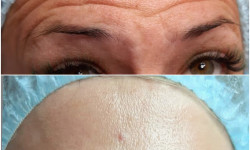 Ботулінотерапія Косметологічний центр O.L.Beauty Київ