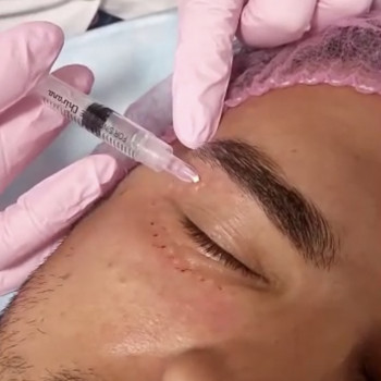 Мезотерапія шкіри навколо очей
                    Косметологический центр O.L.Beauty Киев