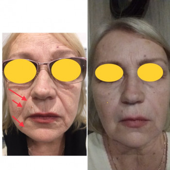 коррекция гидроксиапатитом кальция скуло-щечной зоны лица