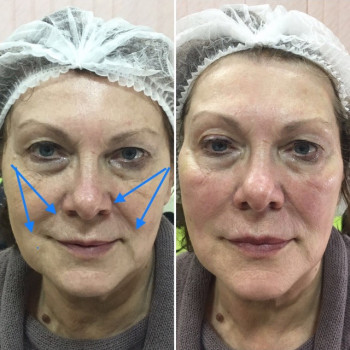 коррекция гидроксиапатитом кальция средней трети лица