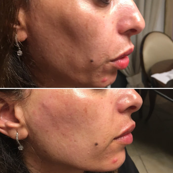 армирование щечной зоны филлером ГК