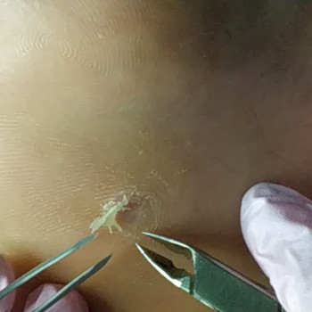 Стрижневий мозоль, фото - подолог Веста Меладзе