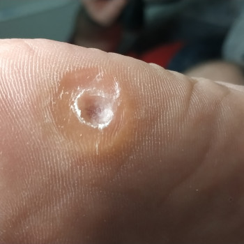 Твердий мозоль, фото - подолог Веста Меладзе