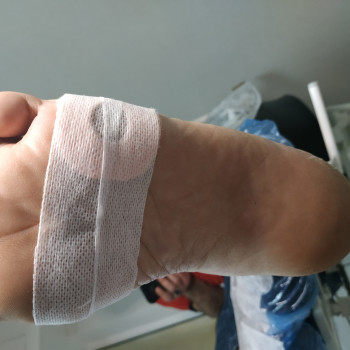 Розвантаження після видалення, фото - подолог Веста Меладзе