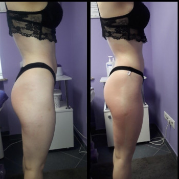 Антицелюлітний вакуумно-роликовий масаж 
                    Масажист Тетяна Луцьк