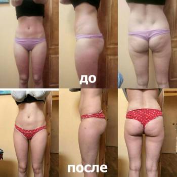 Результат Антицеллюлитного массажа