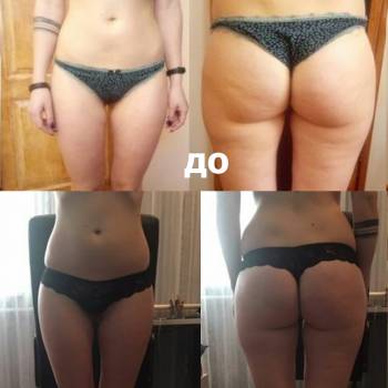 Результат Антицеллюлитного массажа