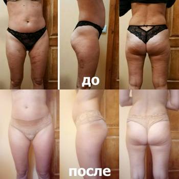 Результат Антицеллюлитного массажа