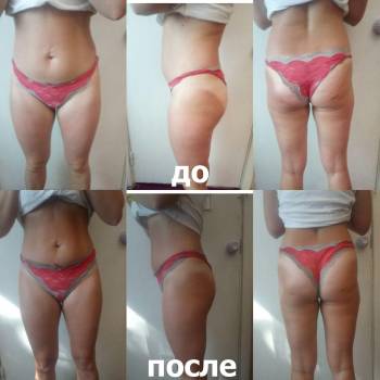 Результат Антицеллюлитного массажа