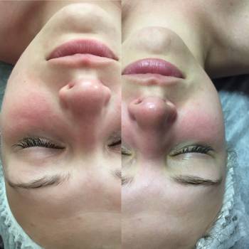 Энзимный пилинг