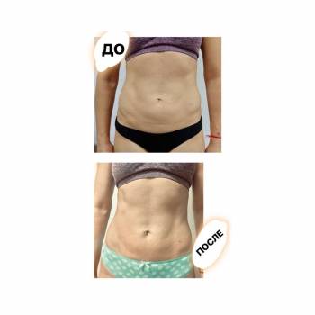 5 процедур вакуумного массажа