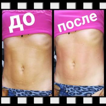 Вакуумно-роликовый массаж - 1 процедура.