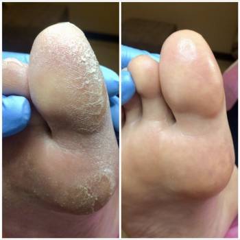 Лечение натоптышей, мозолей и трещин