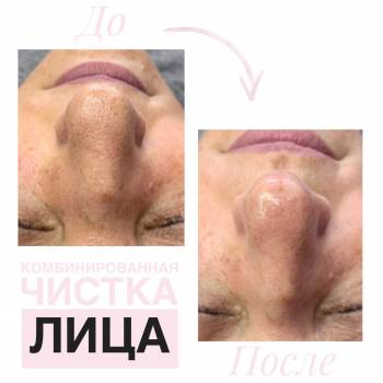 Комбинированная чистка лица