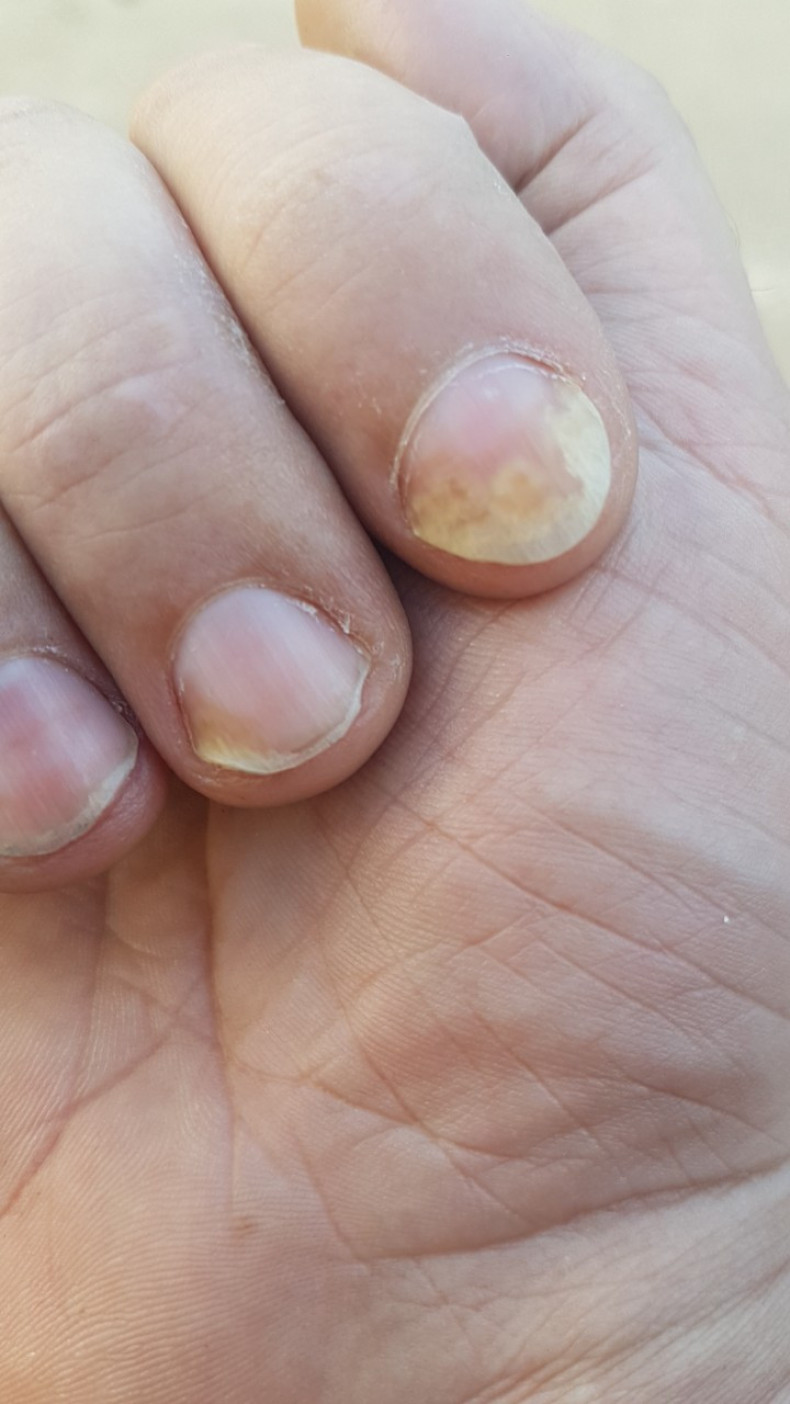 Онихомикоз на руках, фото -  