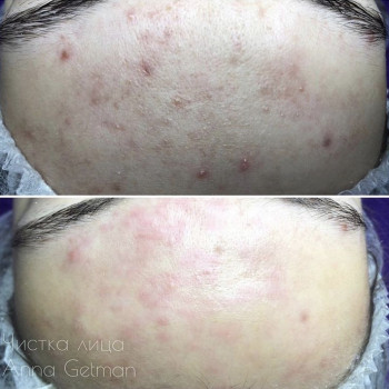 Чистка лица
                    Косметолог Анна Гетьман Харьков
