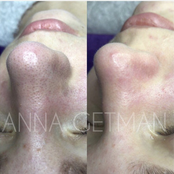 Чистка лица
                    Косметолог Анна Гетьман Харьков