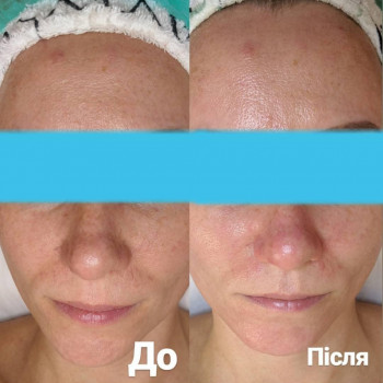 Атравматична чистка обличчя
                    Салон красоты Pure Beauty Львов