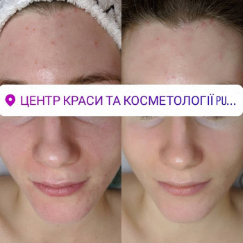 Антиоксидантний та зволожуючий догляд за обличчям
                    Салон краси Pure Beauty Львів