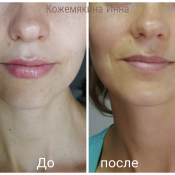  #контуробличча #омолодження