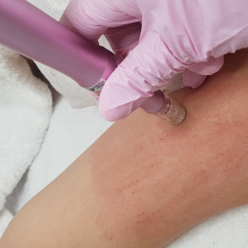 Дермапен (дермаштамп, фракционная мезотерапия)
                    Косметолог-эстетист Марина Сумы