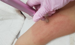 Дермапен (дермаштамп, фракционная мезотерапия) Косметолог-естетист Марина Суми