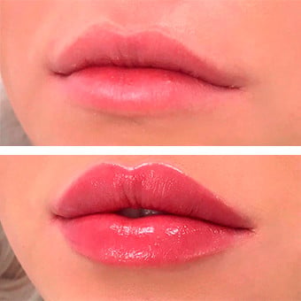 Увеличение губ гиалуроновой кислотой, фото - Врач-косметолог Ирина Нескоромная