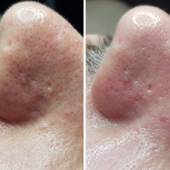 Чистка лица
                    Косметолог Наталія Київ