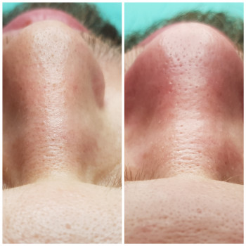 Чистка лица
                    Косметолог Наталія Київ