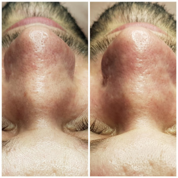 Чистка лица
                    Косметолог Наталія Київ