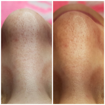 Чистка лица
                    Косметолог Наталія Київ