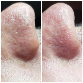 Чистка лица
                    Косметолог Наталія Київ