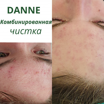 Комбінована чистка обличчя, фото - косметолог Ирина Тищенко