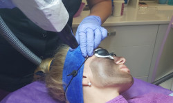 Лазерный карбоновый пилинг Косметологічний центр ASA LASER COSMETIC Київ