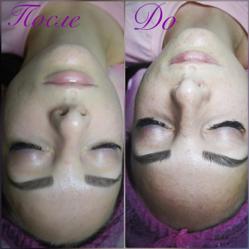 Курс миндального пилинга по супер цене
                    Косметолог Дарья Одеса