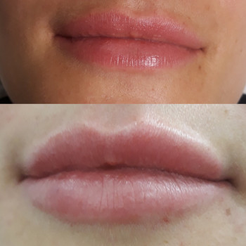 Збільшення губ
                    Салон краси Wizard Київ