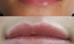 Збільшення губ Салон краси Wizard Київ