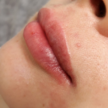 Збільшення губ
                    Салон краси Wizard Київ