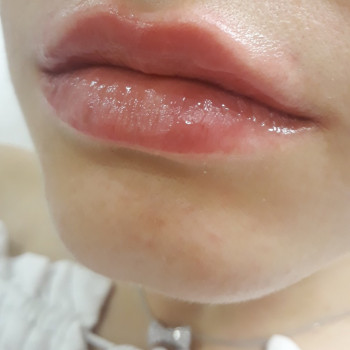 Збільшення губ
                    Салон краси Wizard Київ