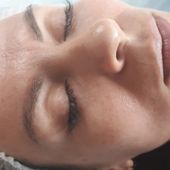 Карбоновый пилинг (лазерный)
                    Косметолог-эстетист Алена Киев