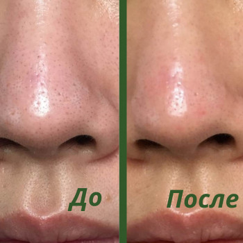 Атравматическая чистка жирной кожи