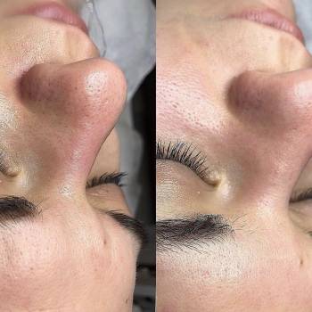 Комбінована чистка обличчя