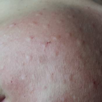 Биоревитализация