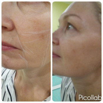  
 
37 лет. Коррекция нижней трети. До и сразу после процедуры