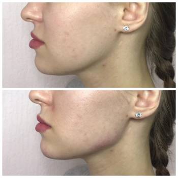 Углы нижней челюсти