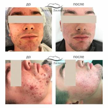Комплексное лечение проблемной кожи