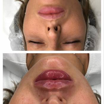 Контурная пластика губ