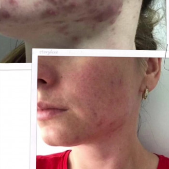 Лікування акне
                    Косметолог-ін'єкціоніст Оксана Львів